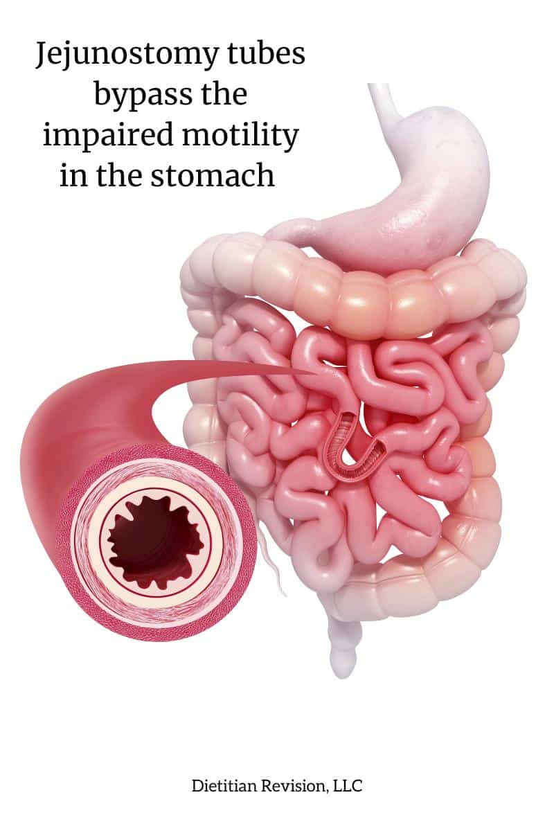 Picture of intestines with text: jejunostomy tubes bypass the impaired motility in the stomach.