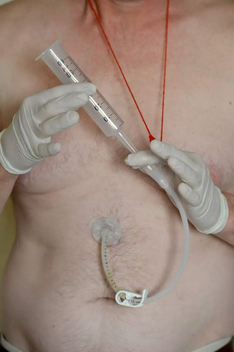 Older male chest and stomach with feeding tube, feeding being administered by gloved hands.